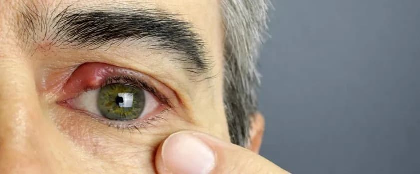 Skuteczne leki na jęczmień: Jak szybko złagodzić objawy?